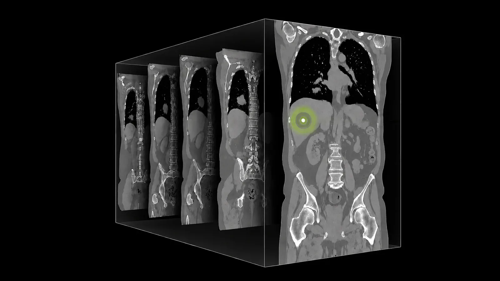 NVIDIA's NV-Reason-CT Brings Chain-of-Thought Reasoning to 3D CT Analysis
